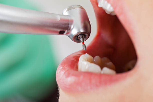 Best Emergency Tooth Extraction in Grayvle, IL